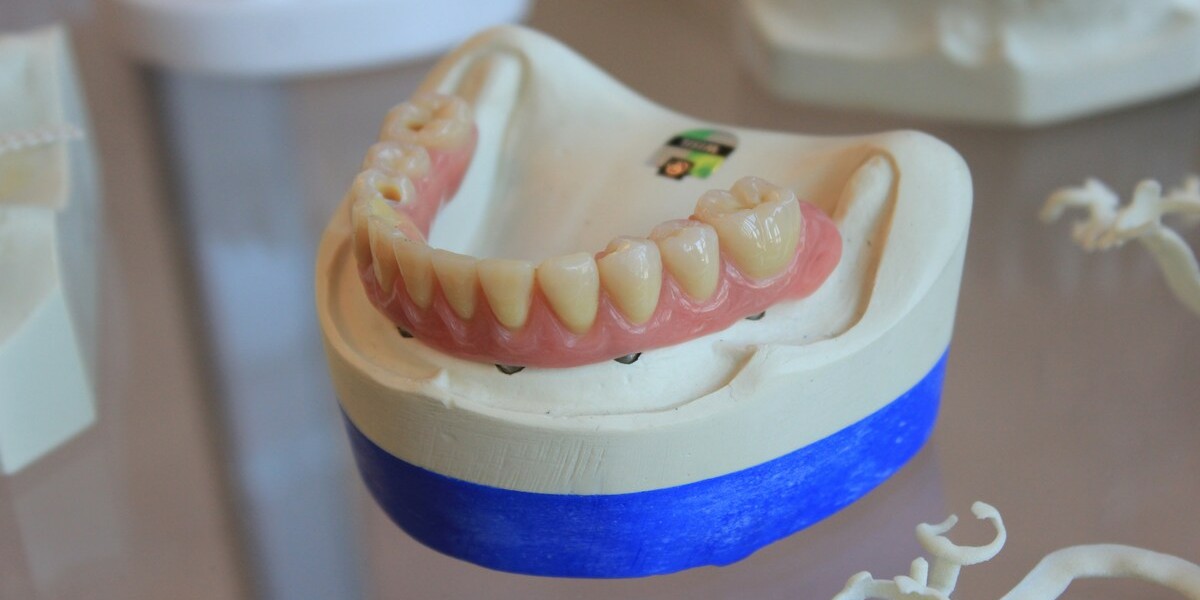Bonus dentista 2025 Protesi dentale